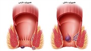 بواسیر یا هموروئید چیست؟ 