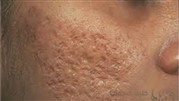 جوش سر سیاه آکنه از پیشانی تا چانه