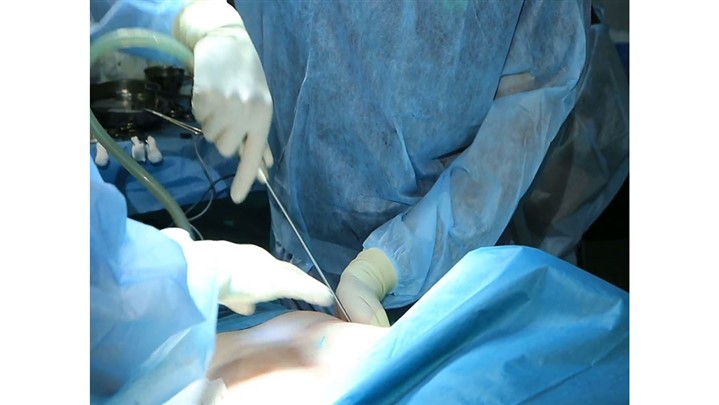 انواع روش های جراحی لاغری کدام اند و چه عوارضی دارند؟