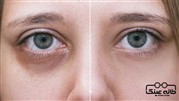 دلیل سیاه شدن زیر چشم و گودی آن