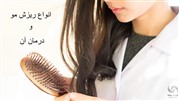   انواع ریزش مو و درمان آن، چگونه می توان از ریزش مو جلوگیری کرد؟