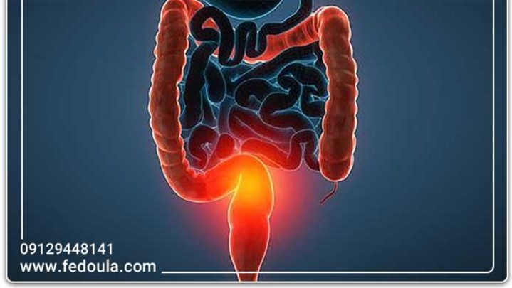 بررسی انواع کولیت روده و علت هر کدام !! بررسی انواع کولیت روده و علت هر کدام !!