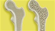 راهکارهای گریز از پوکی استخوان، بیماری قرن