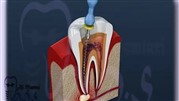 درمان ریشه دندان