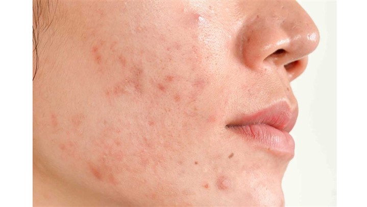 بهترین شوینده برای پوست چرب و جوش دار کدام است؟ بهترین شوینده برای پوست چرب و جوش دار کدام است؟