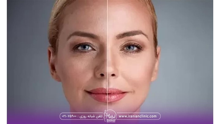 اندولیفت صورت چیست؟