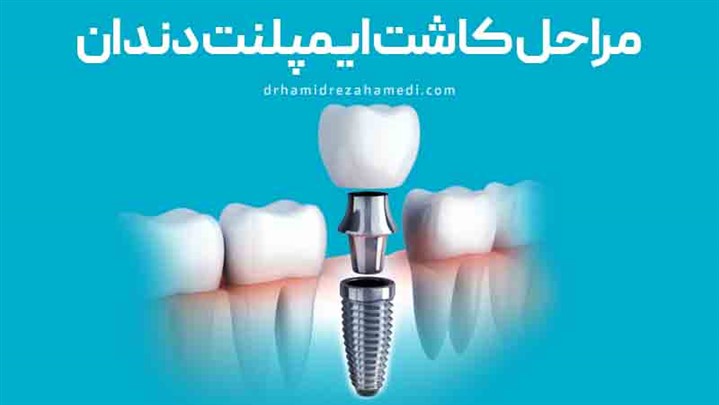 مراحل کاشت ایمپلنت دندان