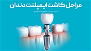 مراحل کاشت ایمپلنت دندان