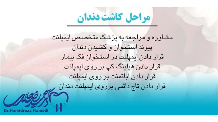 مراحل کاشت ایمپلنت دندان