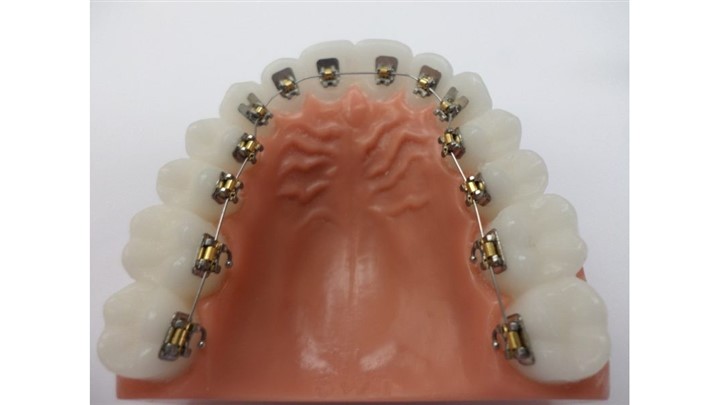 همه چیز درباره ارتودنسی ثابت