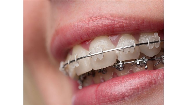 همه چیز درباره ارتودنسی ثابت