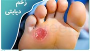 دیابت چیست؟ پیش دیابت، علائم، زخم پای دیابتی/ نشانه ها و انواع آن 2022