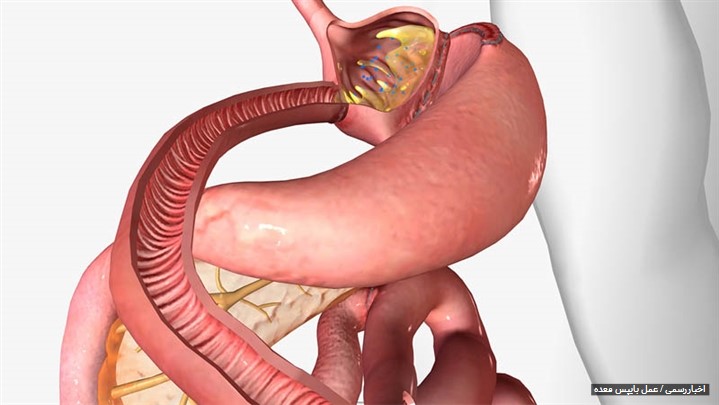 بایپس معده [ برگ برنده برای کسانی که چاقی مفرط دارند ]