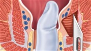  چهار روش عمل جراحی شقاق مقعدی مزمن و مزایای لیزر