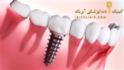 قیمت ایمپلنت دندان در دندانپزشکی آیریک
