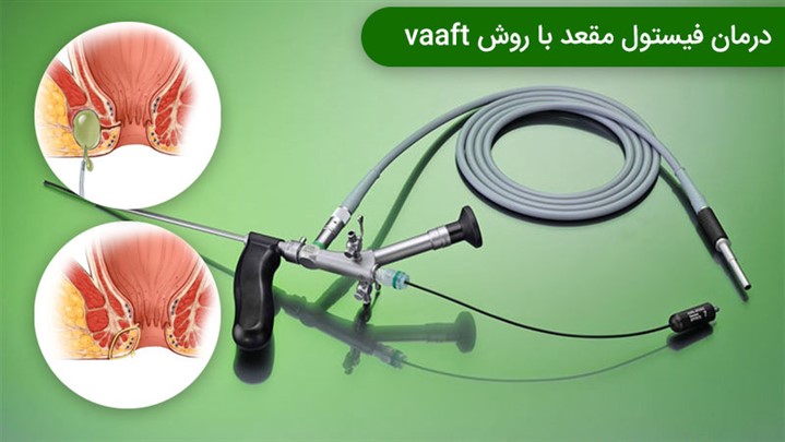 مزایای درمان فیستول با روش VAAFT و مراقبت های بعد از عمل مزایای درمان فیستول با روش VAAFT و مراقبت های بعد از عمل