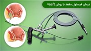مزایای درمان فیستول با روش VAAFT و مراقبت‌های بعد از عمل