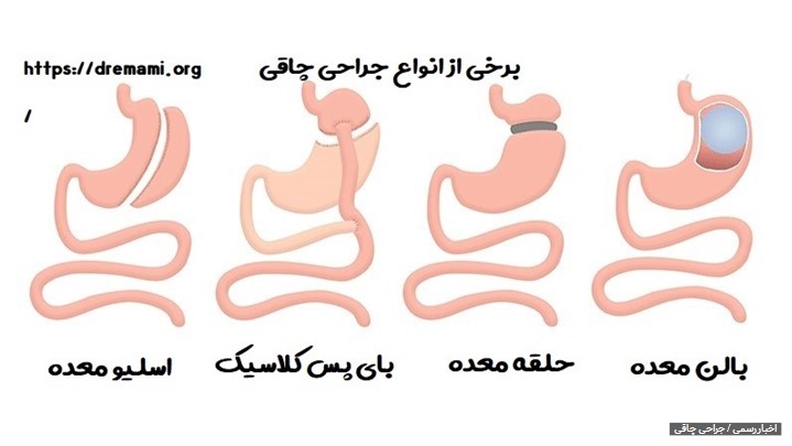 آشنایی با انواع مختلف جراحی چاقی آشنایی با انواع مختلف جراحی چاقی