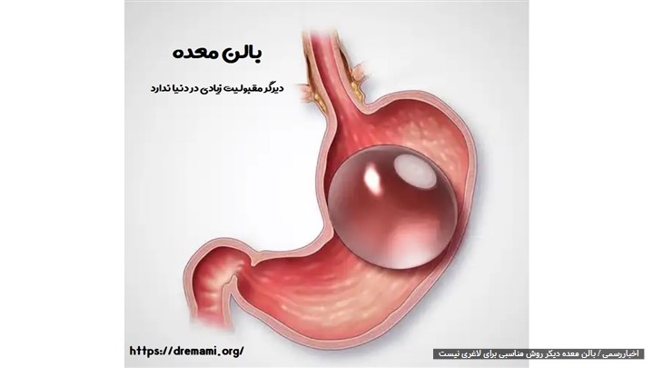 آشنایی با انواع مختلف جراحی چاقی آشنایی با انواع مختلف جراحی چاقی