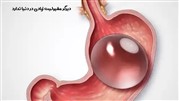 آشنایی با انواع مختلف جراحی چاقی آشنایی با انواع مختلف جراحی چاقی