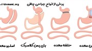 آشنایی با انواع مختلف جراحی چاقی