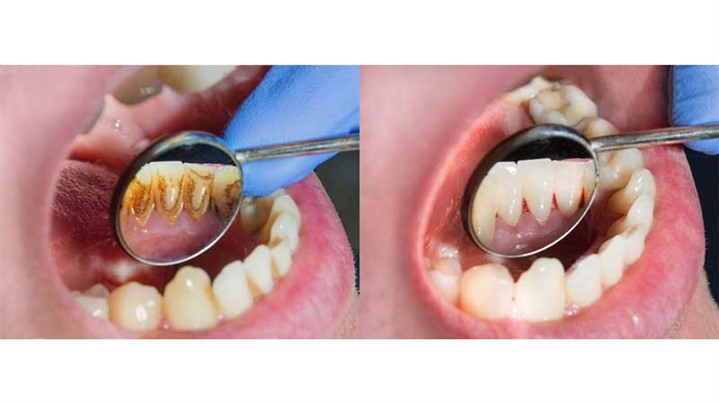 هزینه جرم گیری دندان [مقایسه قیمت با انواع بیمه]