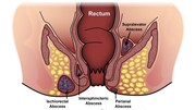 بیماری فیستول مقعد و علل ایجاد انواع این بیماری دردناک