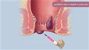 مزایا و معایب درمان بواسیر یا هموروئید به روش اسکلروتراپی