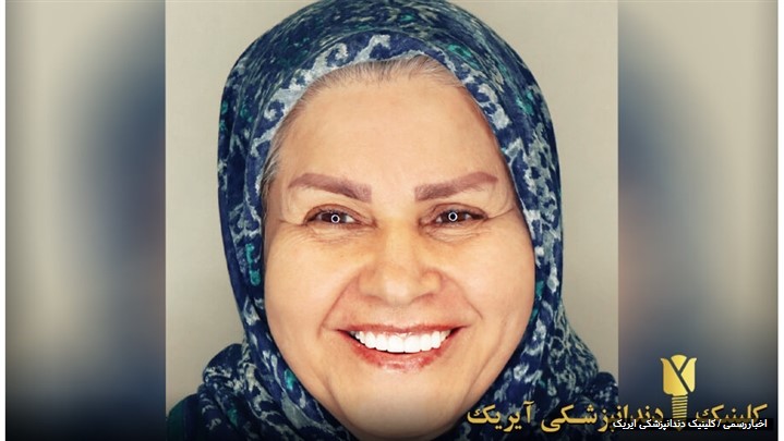 قیمت لمینت دندان 1400 (تخفیف ویژه)