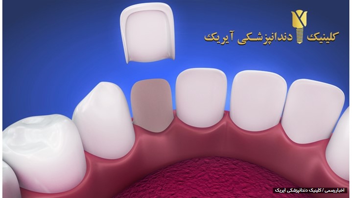 قیمت لمینت دندان 1400 (تخفیف ویژه)