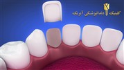 قیمت لمینت دندان 1400 (تخفیف ویژه)