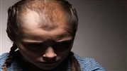چرا سن ریزش مو در جوانان پایین آمده است؟