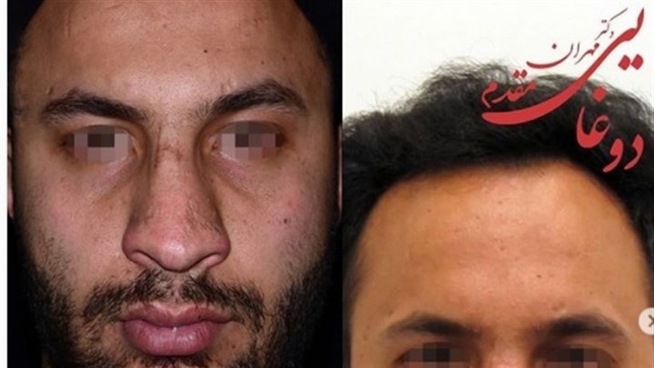 جراحی بینی الان با گذشته چه فرقی دارد؟