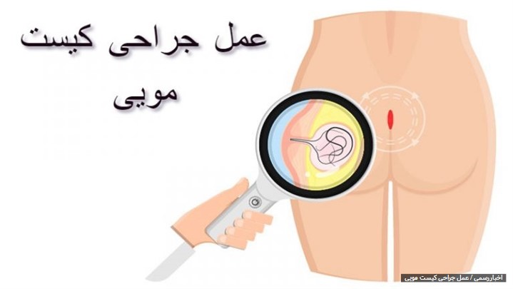 عمل جراحی کیست مویی به روش بسته و باز عمل جراحی کیست مویی به روش بسته و باز