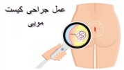 عمل جراحی کیست مویی به روش بسته و باز