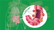 علائم تشخیص دیورتیکولیت و عوارض جانبی این بیماری بر کولون سیگموئید