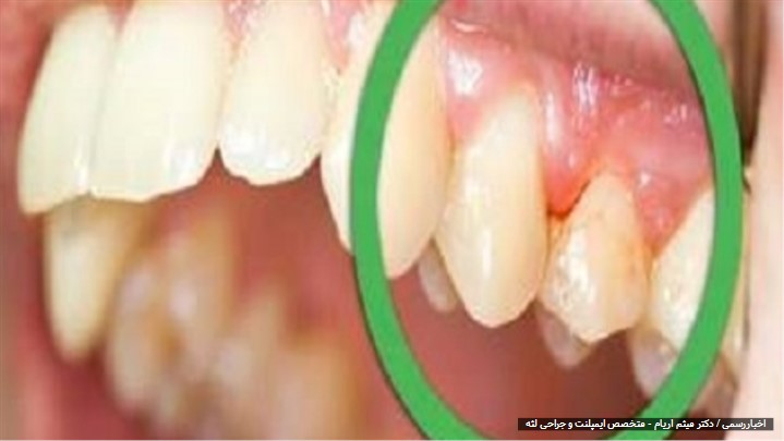 تأثیر بیماری لثه (پریودنتال) بر روی کاشت ایمپلنت تأثیر بیماری لثه (پریودنتال) بر روی کاشت ایمپلنت